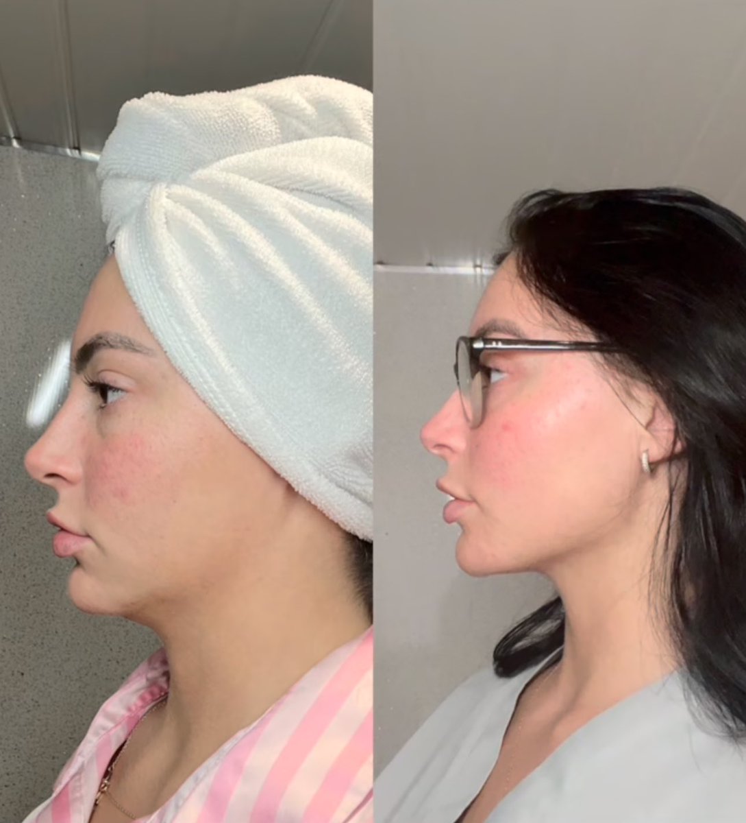 تجربة وحده لفيلر حقن الذهن خفف لها اللغلوغ 
بصراحه النتيجه وهو ومرضيه جـداً 🤩✨