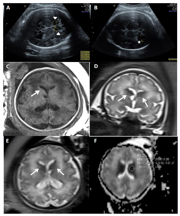 GIMJournal's tweet photo. De novo heterozygous #SP9 variants are responsible for a novel #neurodevelopmental disease #interneuronopathy, #Neomorphic DNA-binding functions #variableexpressivity https://t.co/tBGcTvFbvg https://t.co/TrLj0WAZ78