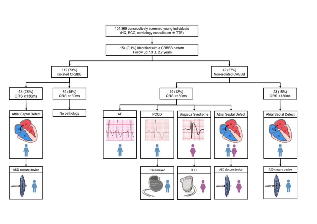 🔴 Prevalence and Clinical Significance of Electrocardiographic Complete RBBB in Young Individuals 💥When should you investigate RBBB in young or athletic individuals? academic.oup.com/eurjpc/advance… #CardioTwitter #Cardiology #medEd #CardioEd #medical #Cardiogen #medtwitter