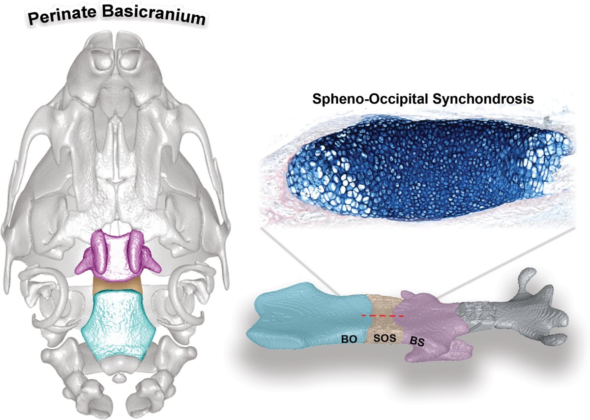 Craniosynostosis presents complex challenge w/180 syndromic associations. Investigating FGFR2 variants sheds light on genetic underpinnings, revealing significant differences in craniofacial features, hinting at novel insights into etiology
Richbourg et al doi.org/10.1002/ar.253…