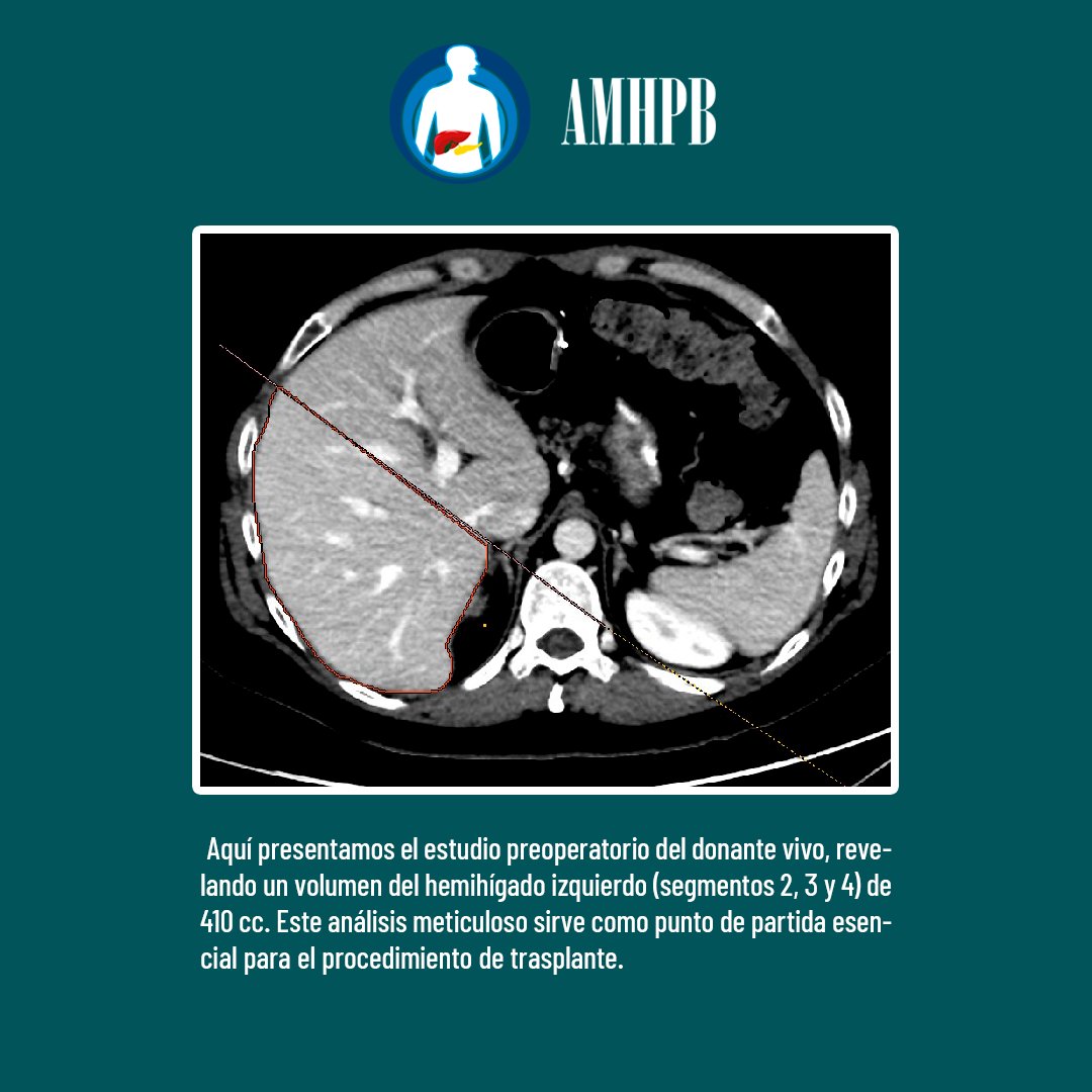 amhpb_mx's tweet photo. ¡Increíble progreso en trasplante hepático de donante vivo!
📸 Foto 1: Aquí presentamos el estudio preoperatorio del donante vivo.
📸 Foto 2: ¡Un hito emocionante en la recuperación!.
#TrasplanteHepatico #DonanteVivo #AMHPB #amhpb2024 https://t.co/hp3Ge1JsUC