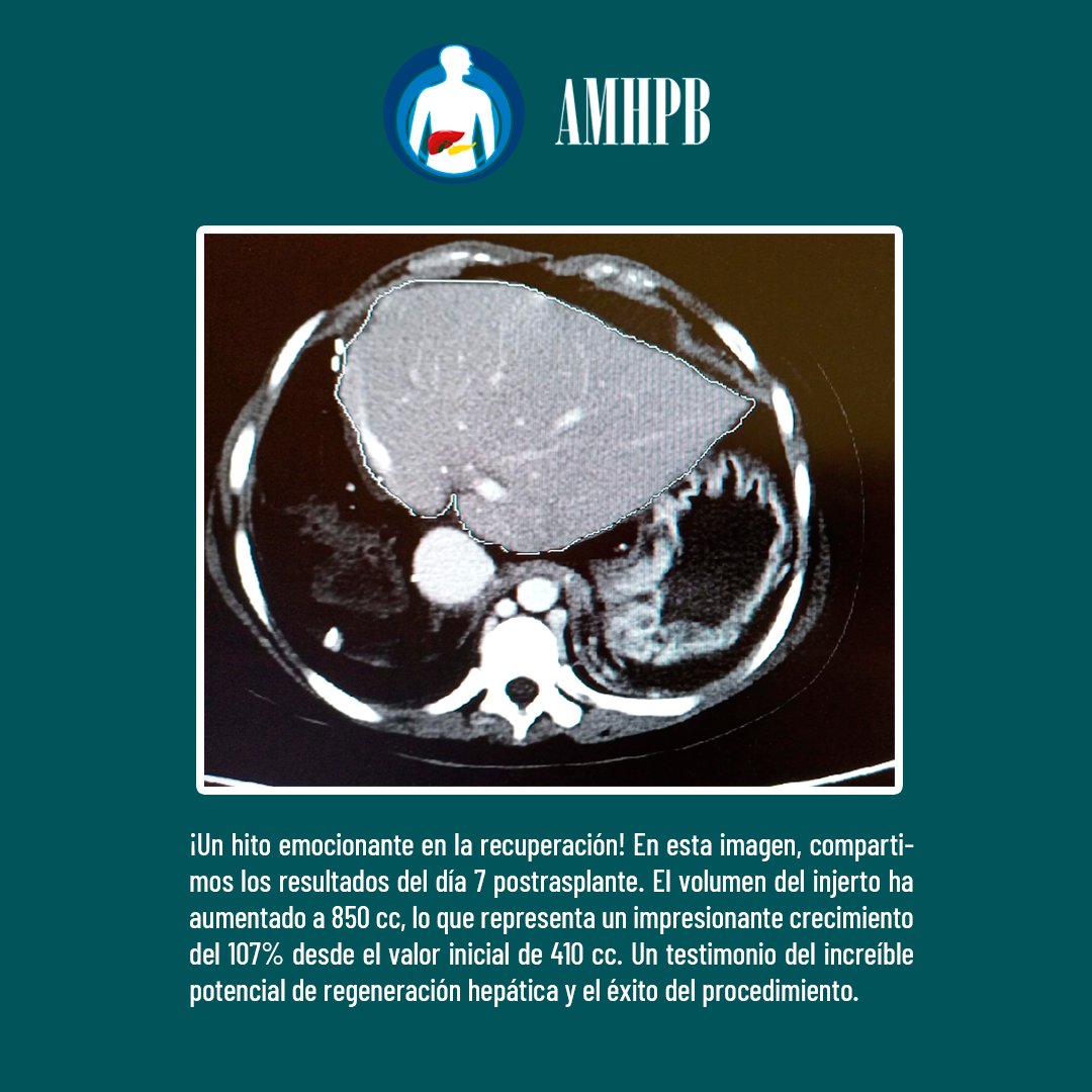 amhpb_mx's tweet photo. ¡Increíble progreso en trasplante hepático de donante vivo!
📸 Foto 1: Aquí presentamos el estudio preoperatorio del donante vivo.
📸 Foto 2: ¡Un hito emocionante en la recuperación!.
#TrasplanteHepatico #DonanteVivo #AMHPB #amhpb2024 https://t.co/hp3Ge1JsUC