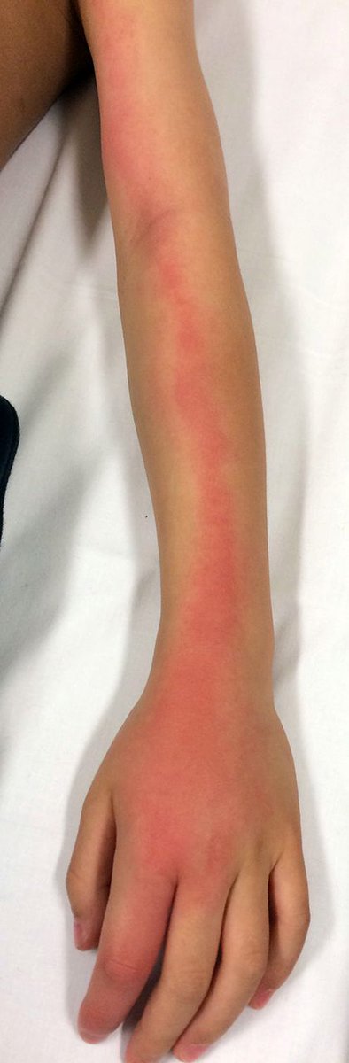 Gazal6849's tweet photo. @IhabFathiSulima 🟤Ascending upper limb #Lymphangitis :Inflammation of the lymphatic channels that occur as a result of infection at a site distal to the channel and may spread within hours.🧬

🟤Group A beta-hemolytic #streptococci are the most common causes of bacterial lymphangitis🦠

#medx https://t.co/UlzPOlXXhU