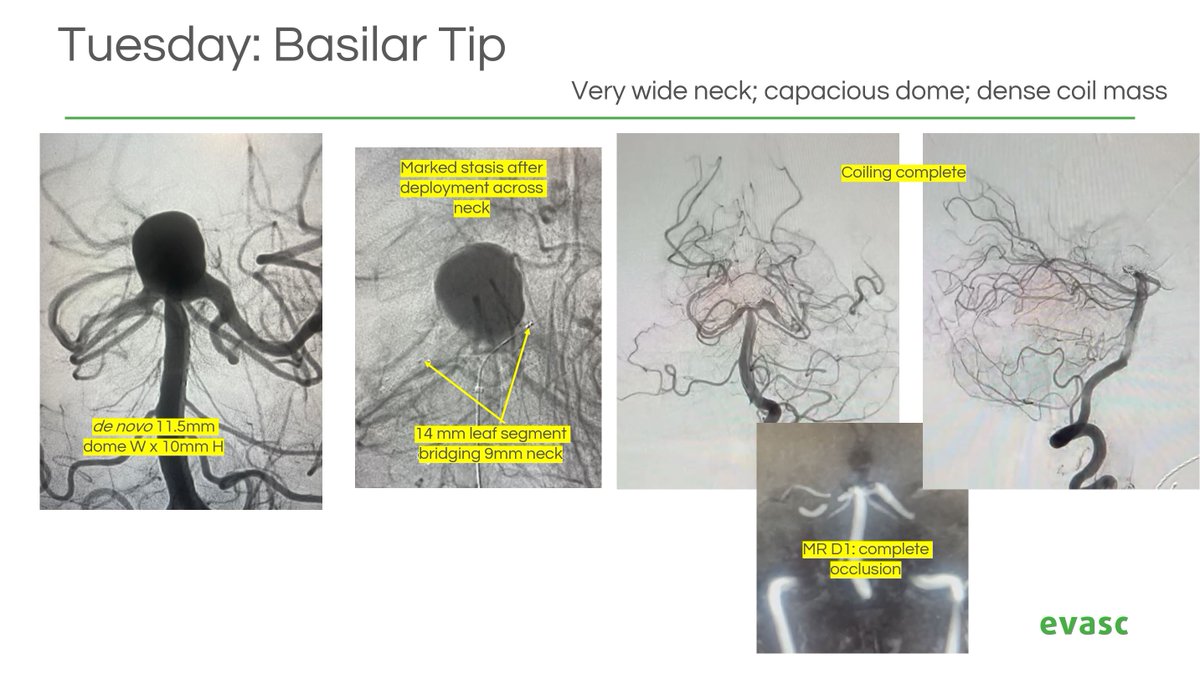 EvascMed's tweet image. Evasc is pleased to share its recent weeklong experience in the United Kingdom, with the able support of our distributor, Delta Surgical. eCLIPs' wide spectrum of applicability is becoming more apparent: