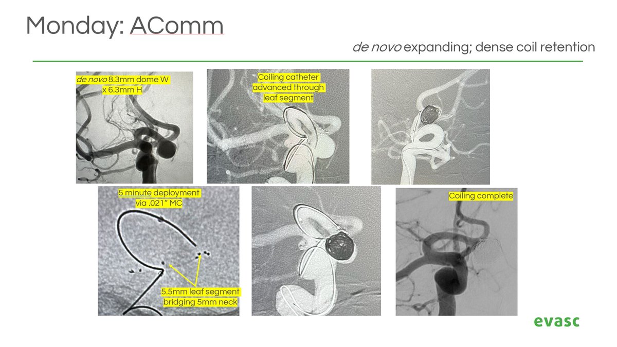 EvascMed's tweet image. Evasc is pleased to share its recent weeklong experience in the United Kingdom, with the able support of our distributor, Delta Surgical. eCLIPs' wide spectrum of applicability is becoming more apparent: