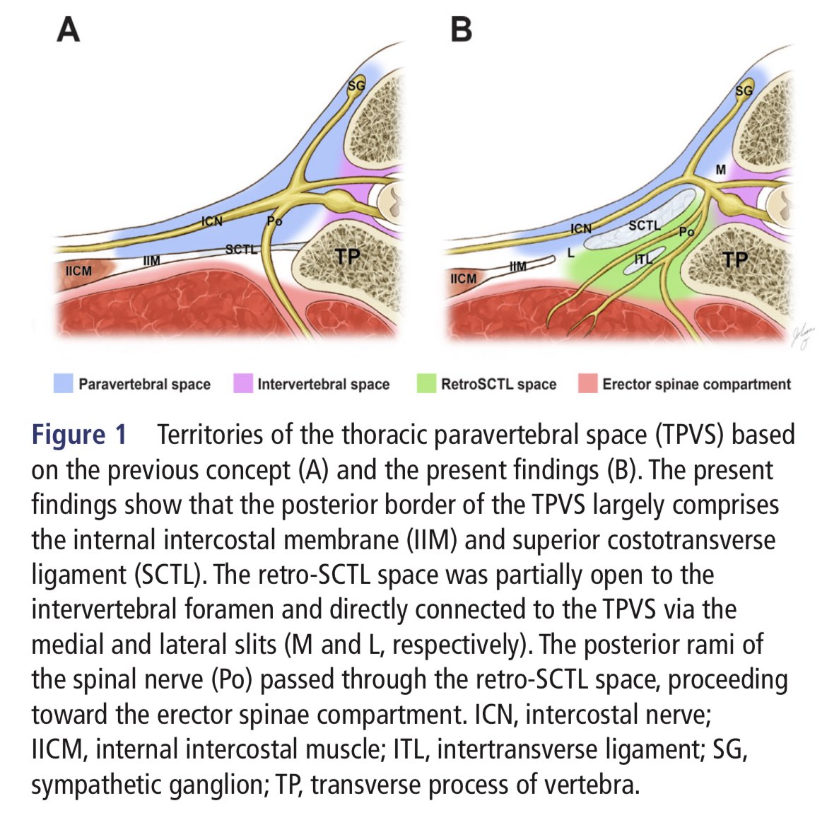 @Steve_Coppens @jon_bailey_anes @amit_pawa @IcostacheIoana @colinjmccartney @Faraj_RegAnesth @ChrisRamnanan @LauradeNeumann2 @BlockIt_Hot_Pod This is the study that is starting to change my mind. Maybe the ESPs that work are actually just ITP blocks? MicroCT study by Cho et al, showing slits in the SCTL for local to pass from retroSCTL space to PV space. rapm.bmj.com/content/rapm/e…