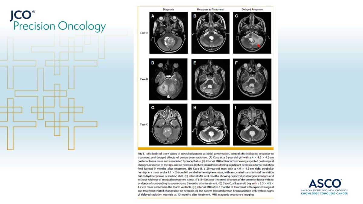 .@rronsley et al. report on three ped pts with #medulloblastoma exhibiting ATM germline or somatic aberrations with variable radiation-induced responses and side effects indicating the possibility of modifying rad dosing with ATM heterozygosity. ➡️ brnw.ch/21wHqbo #pedcsm