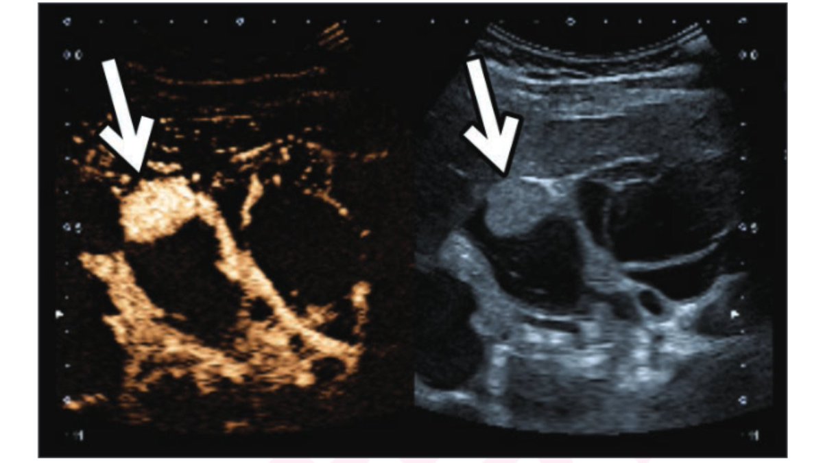 New <a href="/AJR_Radiology/">AJR</a> Accepted Manuscript:

"Contrast-Enhanced Ultrasound of the Indeterminate Renal Mass, From the AJR 'How We Do It' Special Series"

By Drs Elbanna, Atri, &amp; team <a href="/UofTMedIm/">UofT Medical Imaging</a> 

ajronline.org/doi/10.2214/AJ…