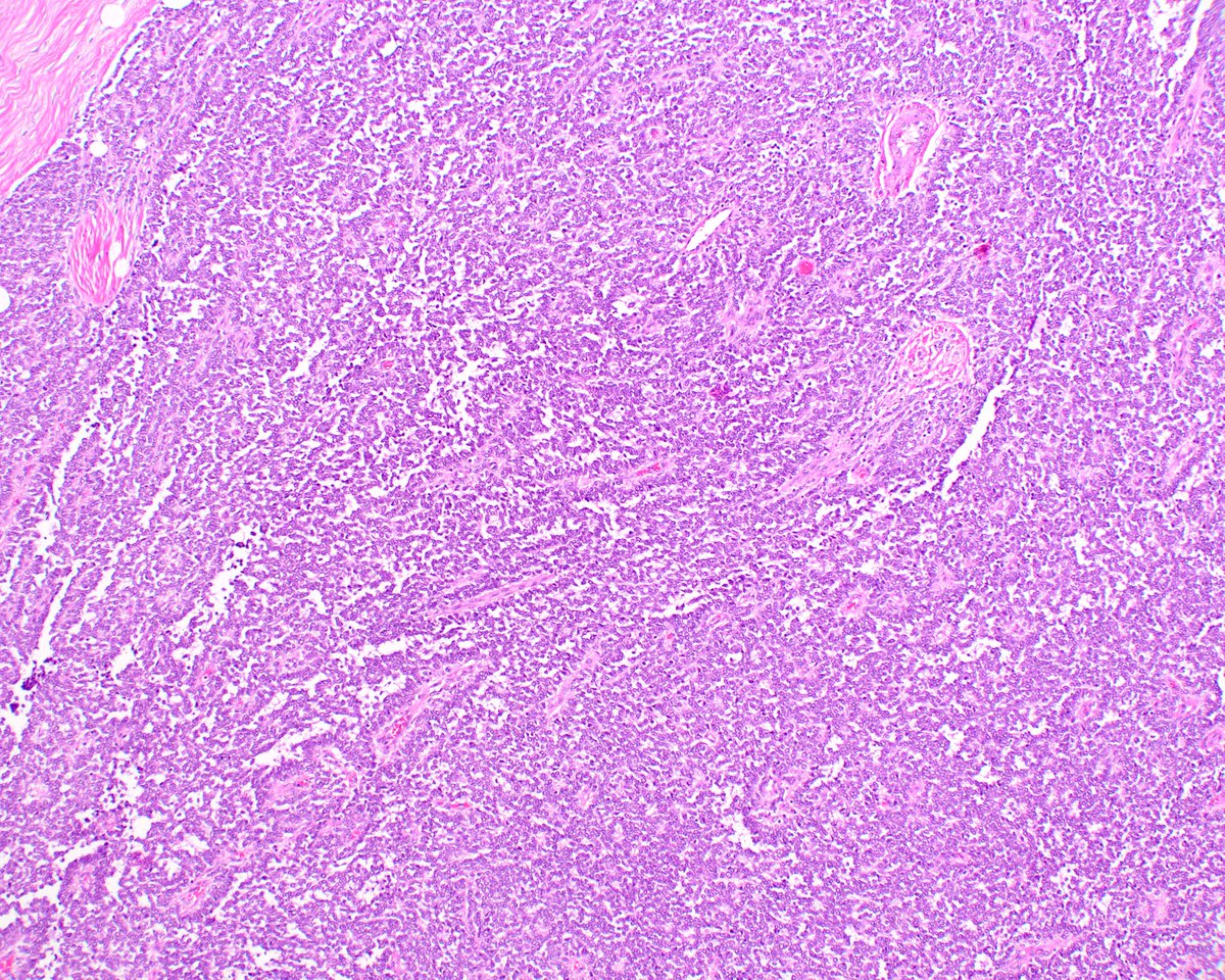 LizMontgomeryMD's tweet photo. This chest wall neoplasm is the old "Askin tumor".  Early discussions concerned Ewing's sarcoma versus primitive neuroectodermal tumor. They're subsumed under Ewing's sarcoma now. So much has changed and so much has not. #UMiamiPath 
Reference; Askin FB,PMID: 222426. https://t.co/tcqeLVyGPV