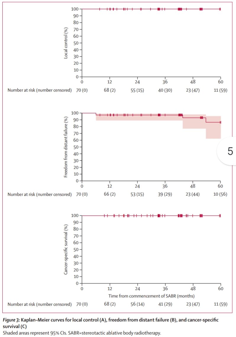 FabArcidiacono8's tweet photo. Congrats @_ShankarSiva &amp;Team
📢Excellent results FASTRACK II phase II trial.#SAbR effective and safe for primary kidney cancer💪🏻Median Tsize 4.6cm.26Gy/SF(33%) 42Gy/3F(67%).Median FU43m,LC &amp; cancer-specific surv💯% 3-y distant-failureFS 97%.Moving FAST to R phase III trial 🔪⚔️☢️ https://t.co/ZAEn1Rm8DF
