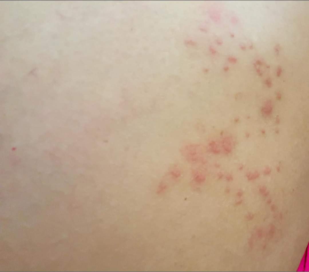 ABSCBNNews's tweet image. WARNING: Sensitive photos  

Manila International Airport Authority apologizes to victims of bed bugs or surot at NAIA.

These photos were posted by one of the victims after she sat at a metal chair at NAIA 3. | via @jekkipascual 

READ: news.abs-cbn.com/news/2024/2/28…