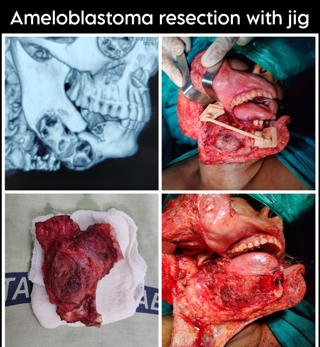 TW- Operative pics Making some collages for the marketing team, I got a chance to revisit some amazing cases I operated during my GCRI stint. Happy to look back on my time there with pride. The institute made me the surgeon that I am, and made me confident to work in private.