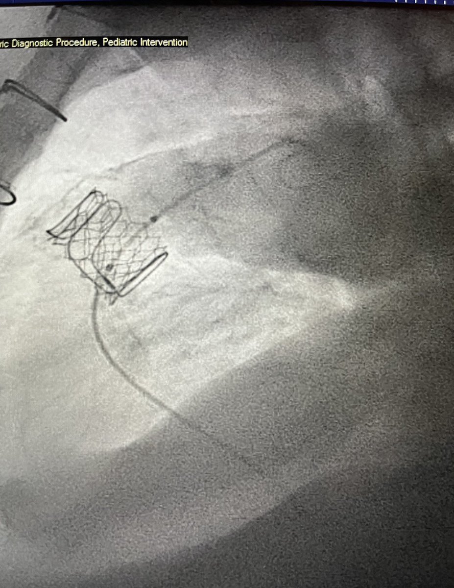 jkurtz02's tweet photo. A great ex. why #CHD is so fun. No case or day is the same. 2nd patient was literally 100x bigger than the first! 1st premie PDA occlusion with @AbbottCardio piccolo then #ACHD patient with #ViV #TPVR @EdwardsLifesci Sapien valve. #radialfirst #pedscards https://t.co/z6LI9zjyjY