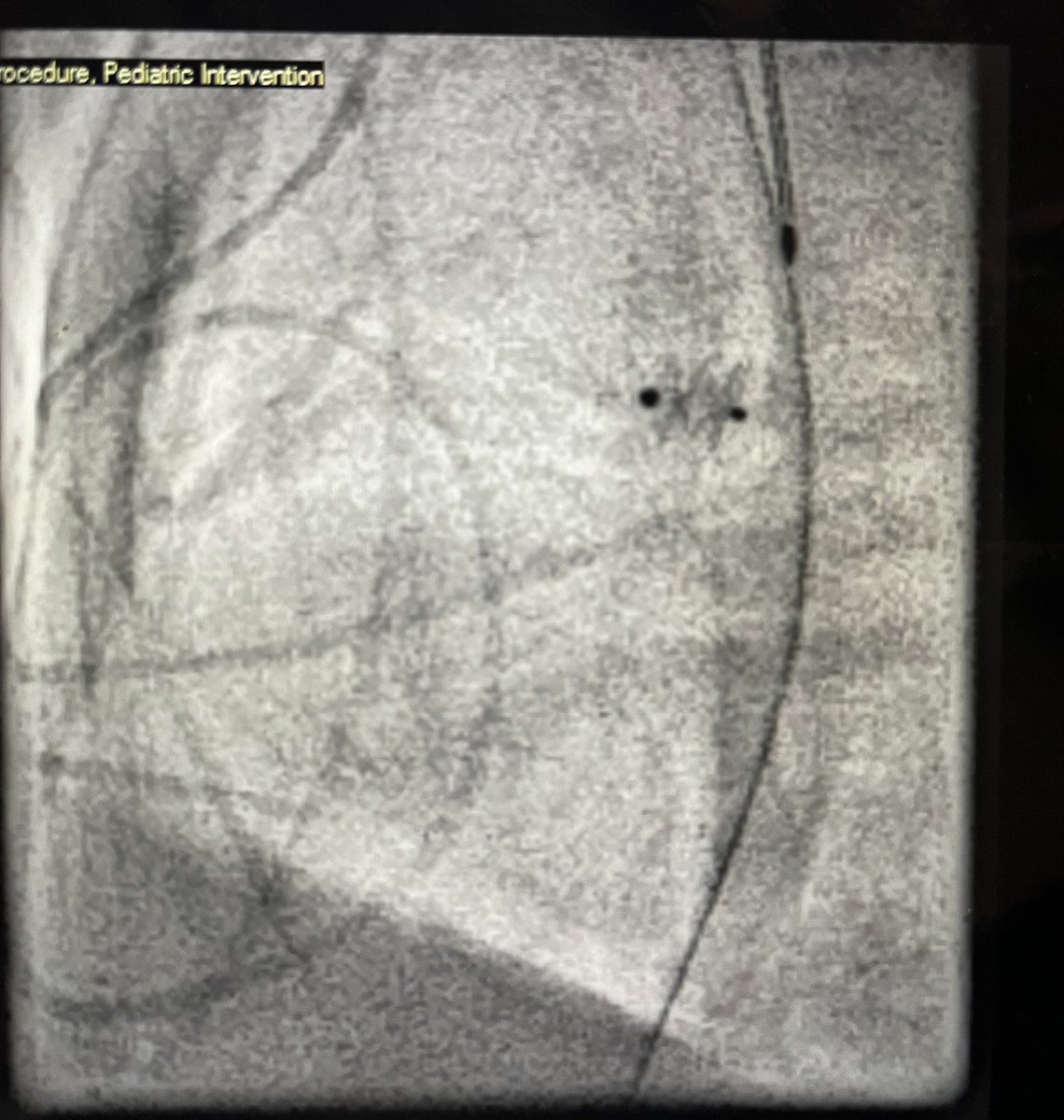 jkurtz02's tweet photo. A great ex. why #CHD is so fun. No case or day is the same. 2nd patient was literally 100x bigger than the first! 1st premie PDA occlusion with @AbbottCardio piccolo then #ACHD patient with #ViV #TPVR @EdwardsLifesci Sapien valve. #radialfirst #pedscards https://t.co/z6LI9zjyjY