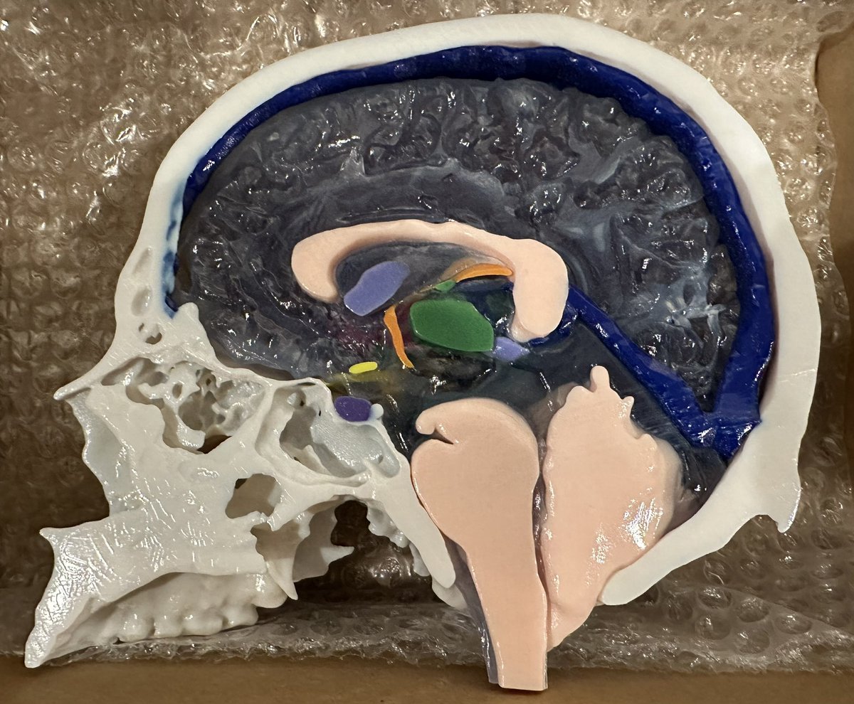 3D printed #SIH brain is ready for CECI2 @AcadRad next week!! Thanks @JayMorris_MD #DaveBlack @MayoRadiology