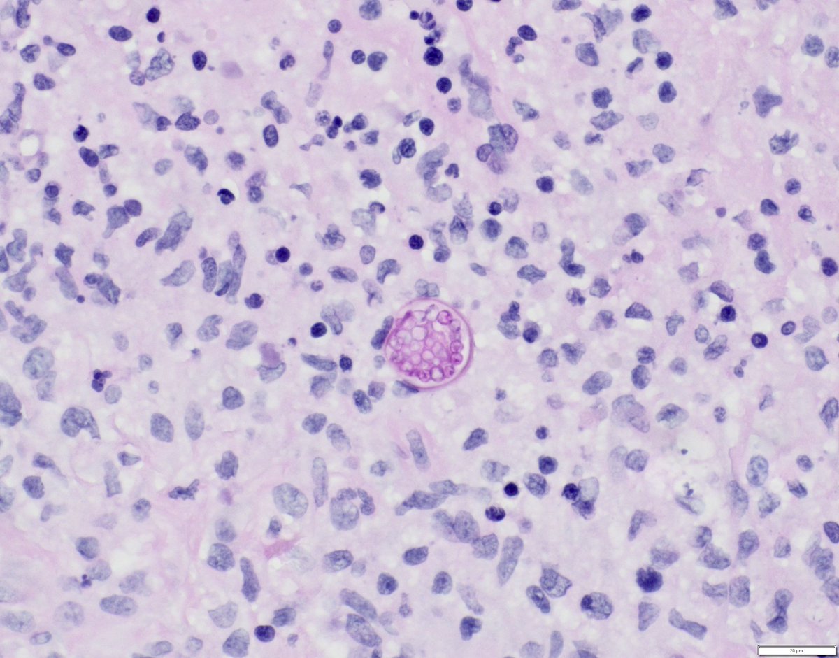 PAS-D stain on a neck mass..based on morphology, what is the likely pathogen? 
#pedipath #microbiology #path #fungi  #MedTwitter 🔬🍄🧐