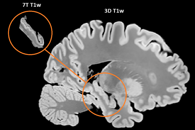 We did a thing! Our first results from "The Douglas Bell Canada Brain Bank Post-mortem Brain Imaging Protocol" biorxiv.org/content/10.110… 
<a href="/YasharZeighami/">Yasharz</a> <a href="/LianaGuerra/">Liana Guerra</a> <a href="/JeremieFouquet/">Jérémie Fouquet</a> <a href="/RoqaMoqa/">roqa moqadam</a> <a href="/zklsmr/">Zaki Alasmar</a> <a href="/mallarchkrvrty1/">Mallar Chakravarty</a> <a href="/DouglasResearch/">Douglas Research Centre</a>