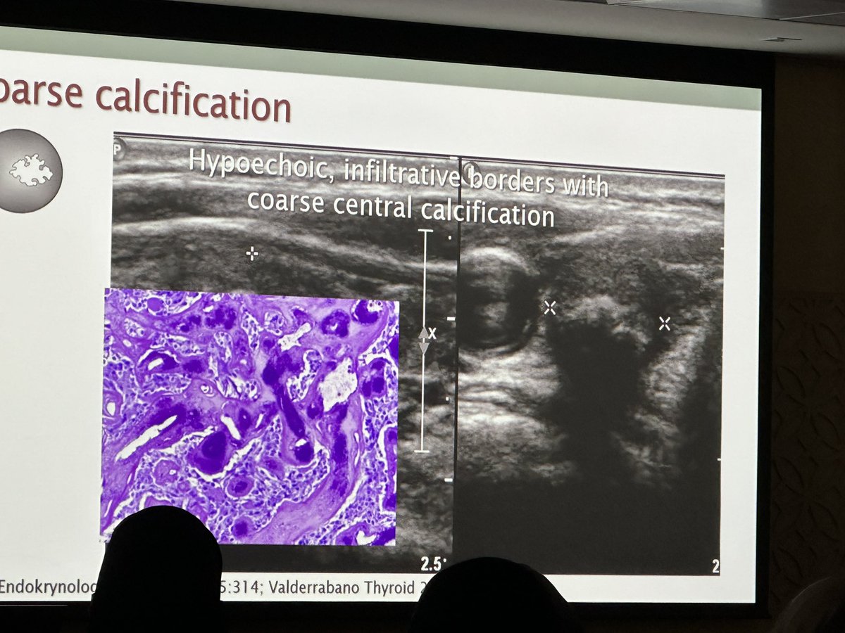 #ice2024 macrocaification in MTCa, great slide by Dr Mandel @PennMedicine @PennPathLabMed @edusqo