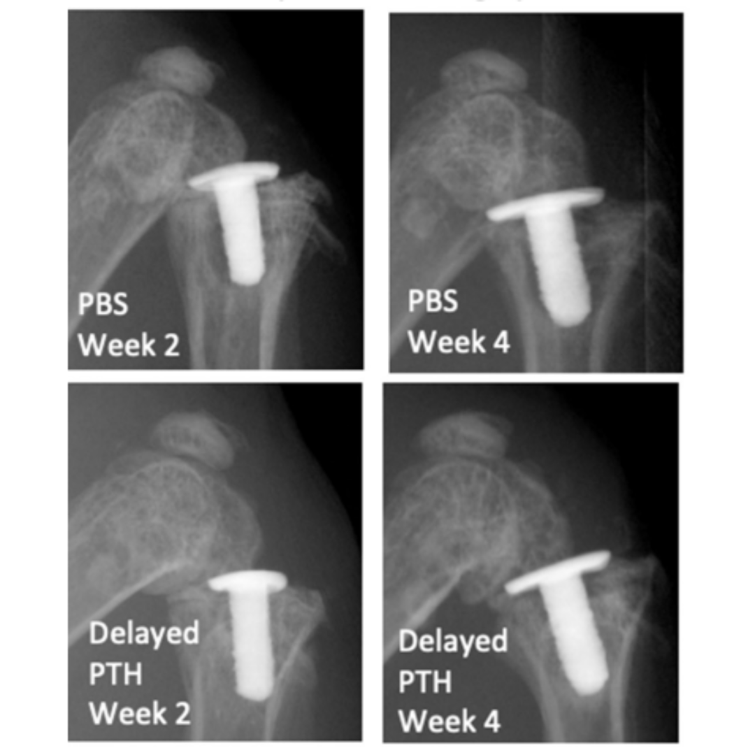 BoneJointRes's tweet photo. Early implant instability can dramatically impair long-term implant survival of arthroplasties. To our knowledge, this is the first study to evaluate implant instability in a murine model with weight-bearing conditions.

#Radiograph #BJR #FOAMed

https://t.co/JqhxsxT9mI https://t.co/6WBRlwGpic