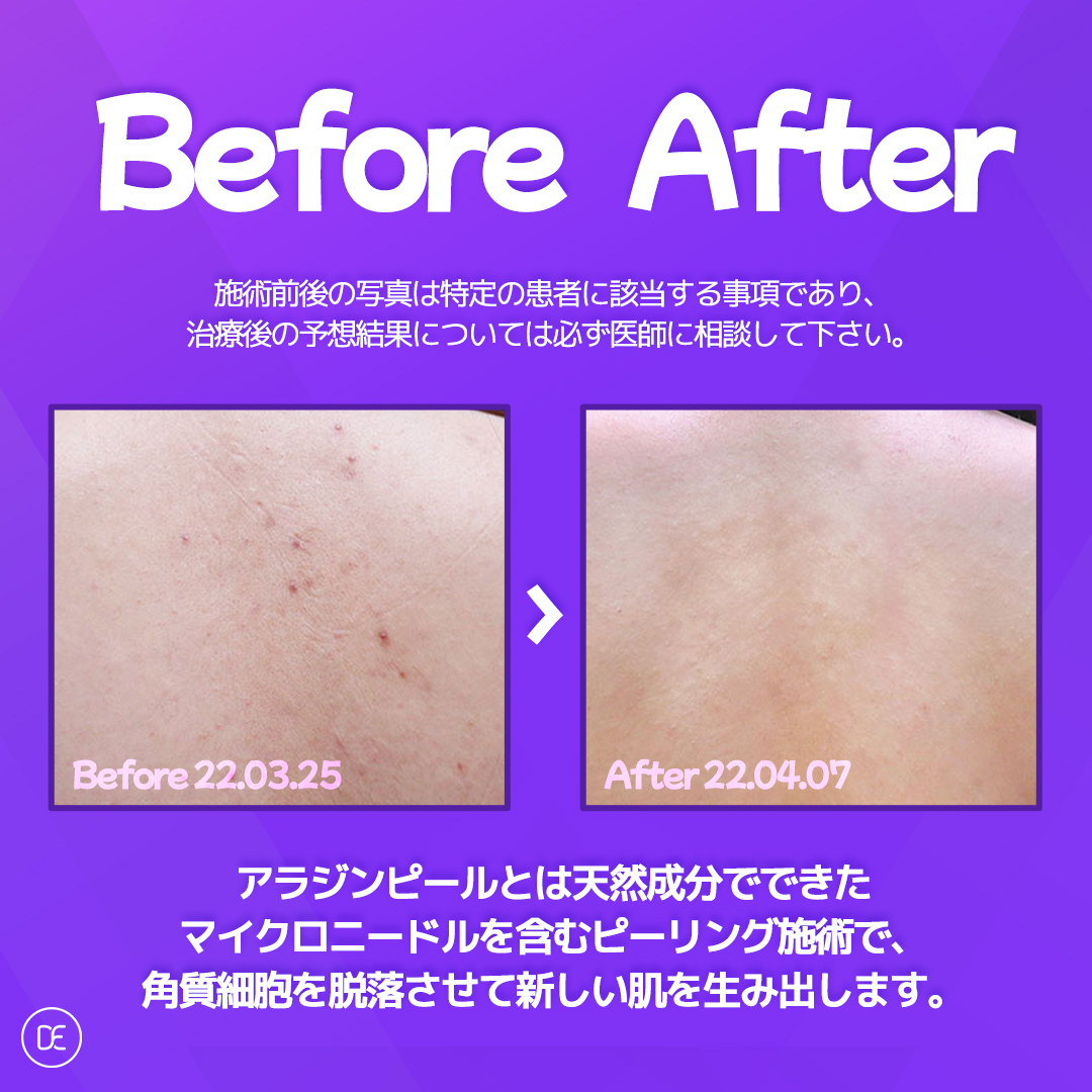 ドクターエバーズの「アラジンピール」✨ サメ肌やニキビ、色素沈着