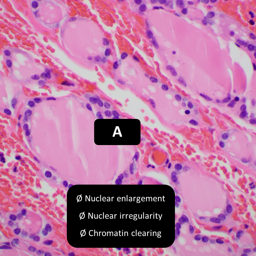 DrCycloPath's tweet photo. Which nuclei are papillary enough for follicular variant papillary thyroid carcinoma?
A, B, C, and D
A, B, and C
C and D
Only D
#EndoPath #PathTwitter #PathResidents
