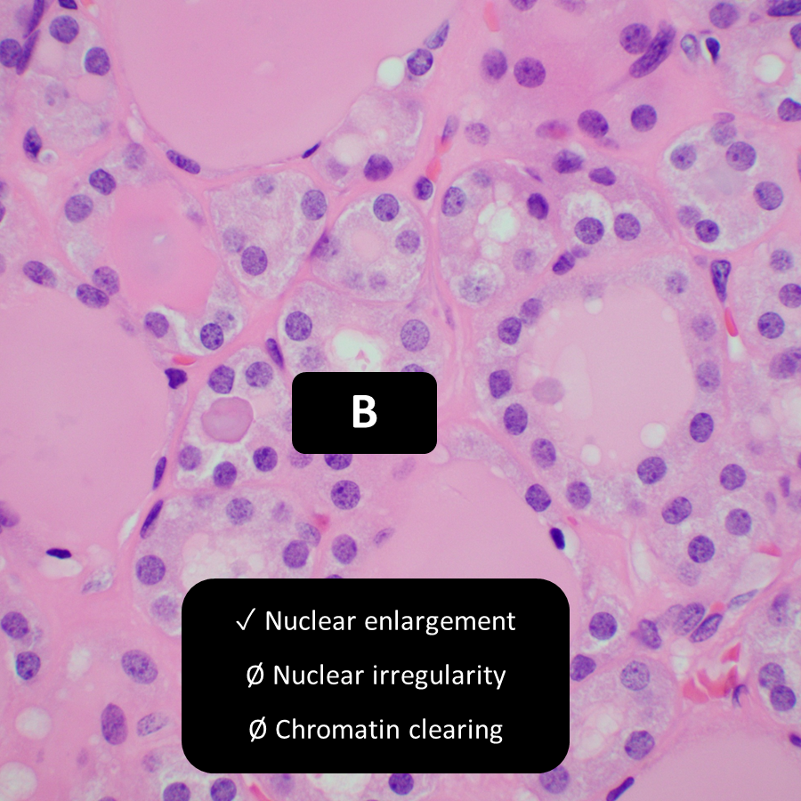 DrCycloPath's tweet photo. Which nuclei are papillary enough for follicular variant papillary thyroid carcinoma?
A, B, C, and D
A, B, and C
C and D
Only D
#EndoPath #PathTwitter #PathResidents