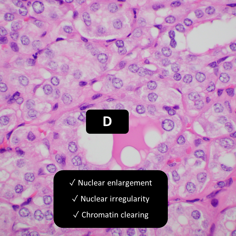 DrCycloPath's tweet photo. Which nuclei are papillary enough for follicular variant papillary thyroid carcinoma?
A, B, C, and D
A, B, and C
C and D
Only D
#EndoPath #PathTwitter #PathResidents