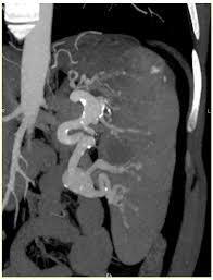 What is the most tortuous artery?