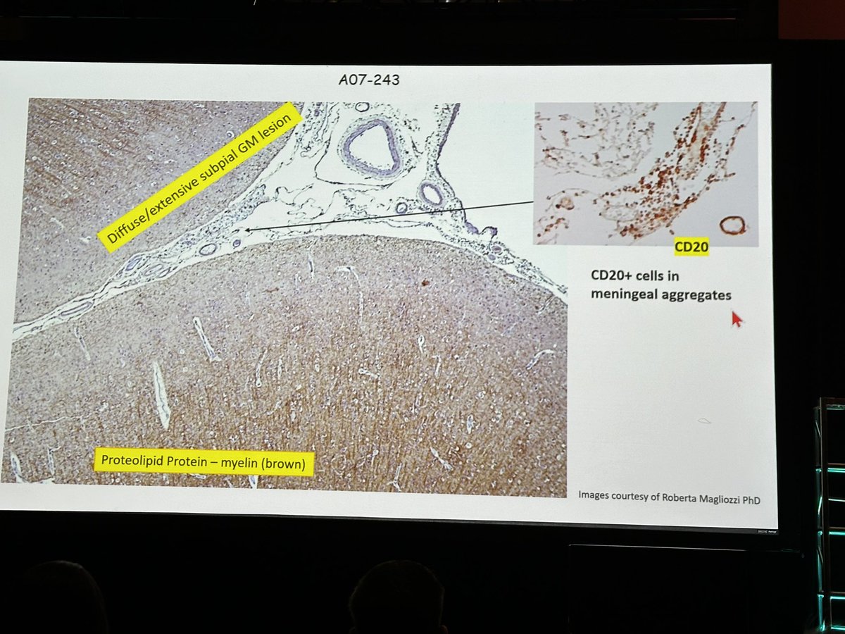 drbarrysinger's tweet image. Cross: 40% of #SPMS patients have ectopic lymphoid aggregates of B cells. Increases risk of severe disability, needing wheelchair.  Also associated with gray matter demyelination.  #ACTRIMS2024 @ACTRIMS