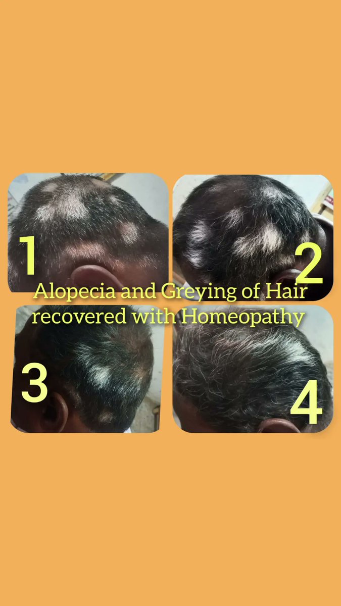 #Alopecia #greyinghair #homeopathy #fastrecovery #naturalhealing