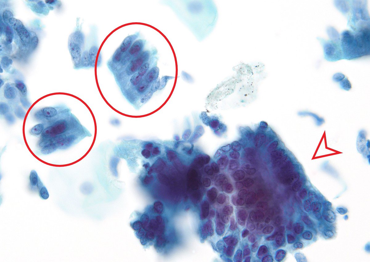 CLASSIC cytomorphology of “Endocervical Adenocarcinoma in-situ (AIS)”. Isolated flat stripping, oval to plump elongated nuclei, nuclear palisading, flat luminal edges and clean smear background. (GYN PAP Test, SurePath)