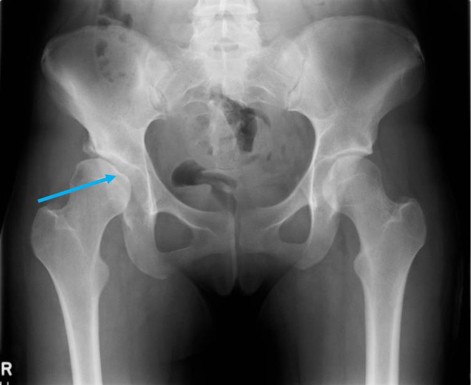 Hip Dysplasia in a Patient in Late Adolescence With Charcot-Marie-Tooth and Multiple Acyl-CoA Dehydrogenase Deficiency journalmc.org/index.php/JMC/…