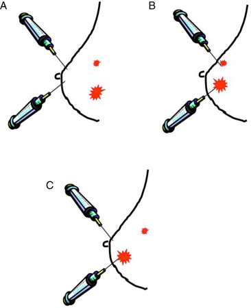 Técnica de la biopsia selectiva del ganglio centinela en tumores multifocales de la mama #bcsm #cancerdemama #bsgc elsevier.es/es-revista-rev…