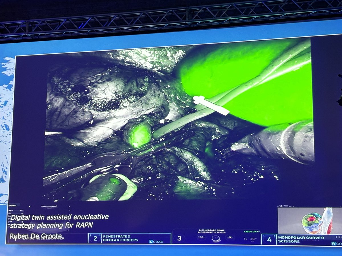 ๐๐๐๐๐๐ง๐๐ค ๐ฝ๐๐ง๐ฉ๐ค๐ก๐ค MD PhD (@ricbertolo) on Twitter photo Great #UroTechnology Live #Surgery day at <a href="/TechnoUro/">13th Techno-Urology Meeting (TUM)</a> meeting.
Perfect organisation by Prof. <a href="/PorpigliaF/">Porpiglia Francesco</a>โs team ๐๐ผ Great #UroTechnology Live #Surgery day at <a href="/TechnoUro/">13th Techno-Urology Meeting (TUM)</a> meeting.
Perfect organisation by Prof. <a href="/PorpigliaF/">Porpiglia Francesco</a>โs team ๐๐ผ