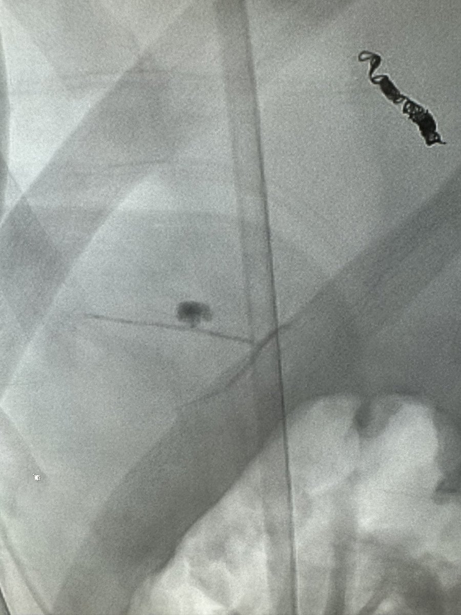 Ahmed Kamel MD, PhD, FSIR (@ahmed_kamel_ir) on Twitter photo Traumatic Pseudoaneyrysm of the liver treated by embolization using #obsidio <a href="/bostonsci/">Boston Scientific</a> <a href="/UTHouston_IR/">UT Houston_IR</a> <a href="/UTHradiology/">UTHealth Houston Radiology</a> <a href="/HCIRad/">Houston Combined IR Residency</a> <a href="/rahmioklu/">Rahmi Oklu MD, PhD</a>
#Trauma #InterventionalRadiology #Hepatictrauma #pseudoaneurysm #MinimallyInvasiveProcedures #GlobalEducation #Embolization #ResidentEducation Traumatic Pseudoaneyrysm of the liver treated by embolization using #obsidio <a href="/bostonsci/">Boston Scientific</a> <a href="/UTHouston_IR/">UT Houston_IR</a> <a href="/UTHradiology/">UTHealth Houston Radiology</a> <a href="/HCIRad/">Houston Combined IR Residency</a> <a href="/rahmioklu/">Rahmi Oklu MD, PhD</a>
#Trauma #InterventionalRadiology #Hepatictrauma #pseudoaneurysm #MinimallyInvasiveProcedures #GlobalEducation #Embolization #ResidentEducation
