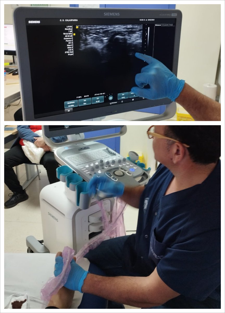 <a href="/Murciasalud/">Murciasalud</a> <a href="/UsuariosanidadM/">UsuariosanidadMurcia</a> <a href="/IsabelAyalaVig/">Isabel Ayala</a> <a href="/smumfyc/">SMUMFYC</a> <a href="/Area4Noroeste/">Área 4 Noroeste</a> <a href="/CCalasparra/">CENTRO DE SALUD DE CALASPARRA</a> <a href="/CS_SanAnton/">Centro de Salud San Antón</a> <a href="/DrWonko/">Maria Medina</a> Infiltración ecoguiada de Neuroma de Morton......#docendodiscimus #atenciónprimariaresolutiva