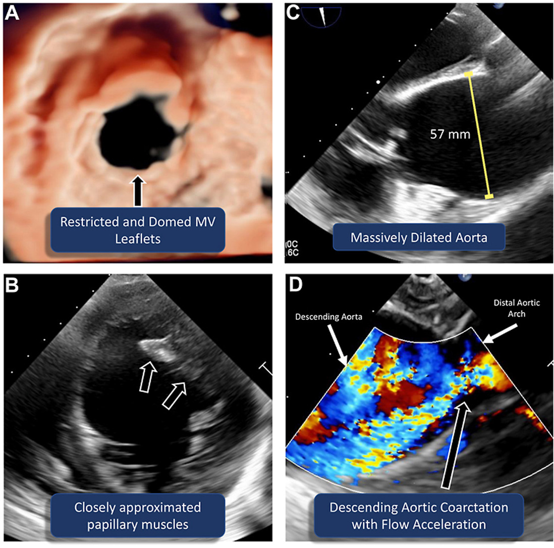 Shone complex (or Shone syndrome) is a rare congenital disorder, which consists of supravalvular mitral ring, parachute mitral valve (MV), subaortic stenosis, and coarctation of the aorta (CoA). Read our @CASEfromASE report: bit.ly/49OaWYO #echofirst