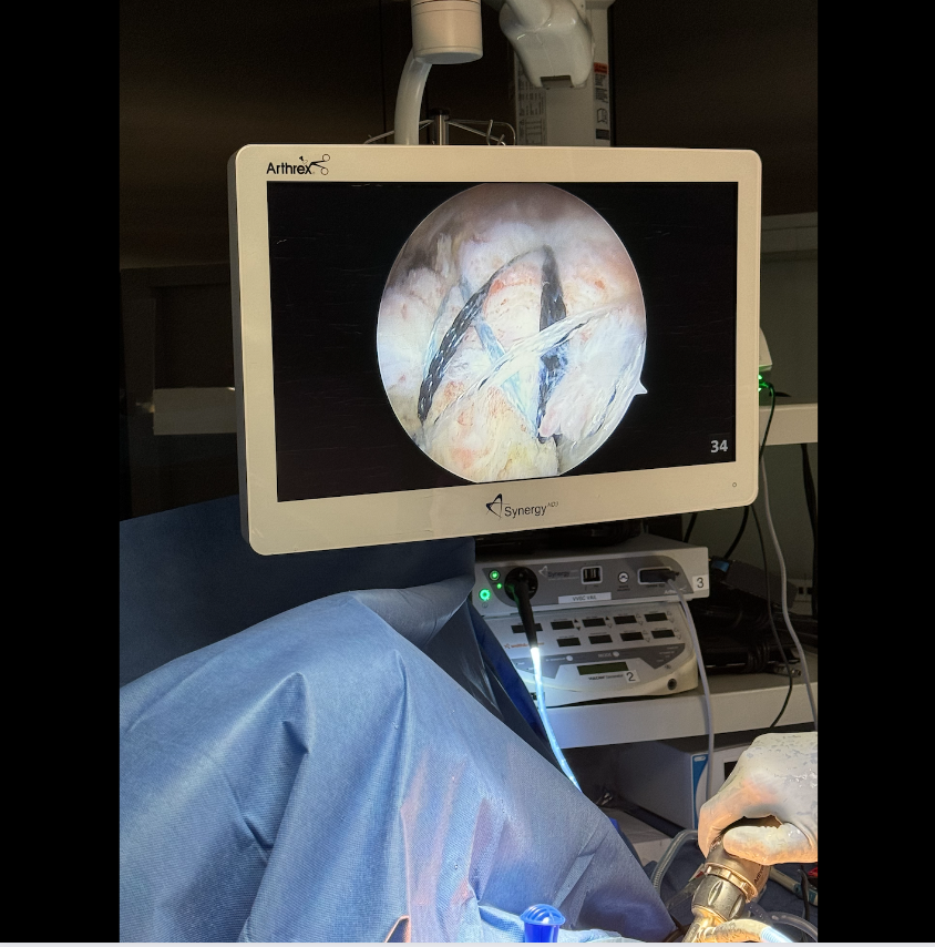 MillettMD's tweet image. Check out Dr. Millett's recent arthroscopic #rotatorcuff repair, showcasing the latest evolution of the #SpeedBridge technique! He helped invent and perfect this method in 2003, and it's still the Gold Standard after 20 years.