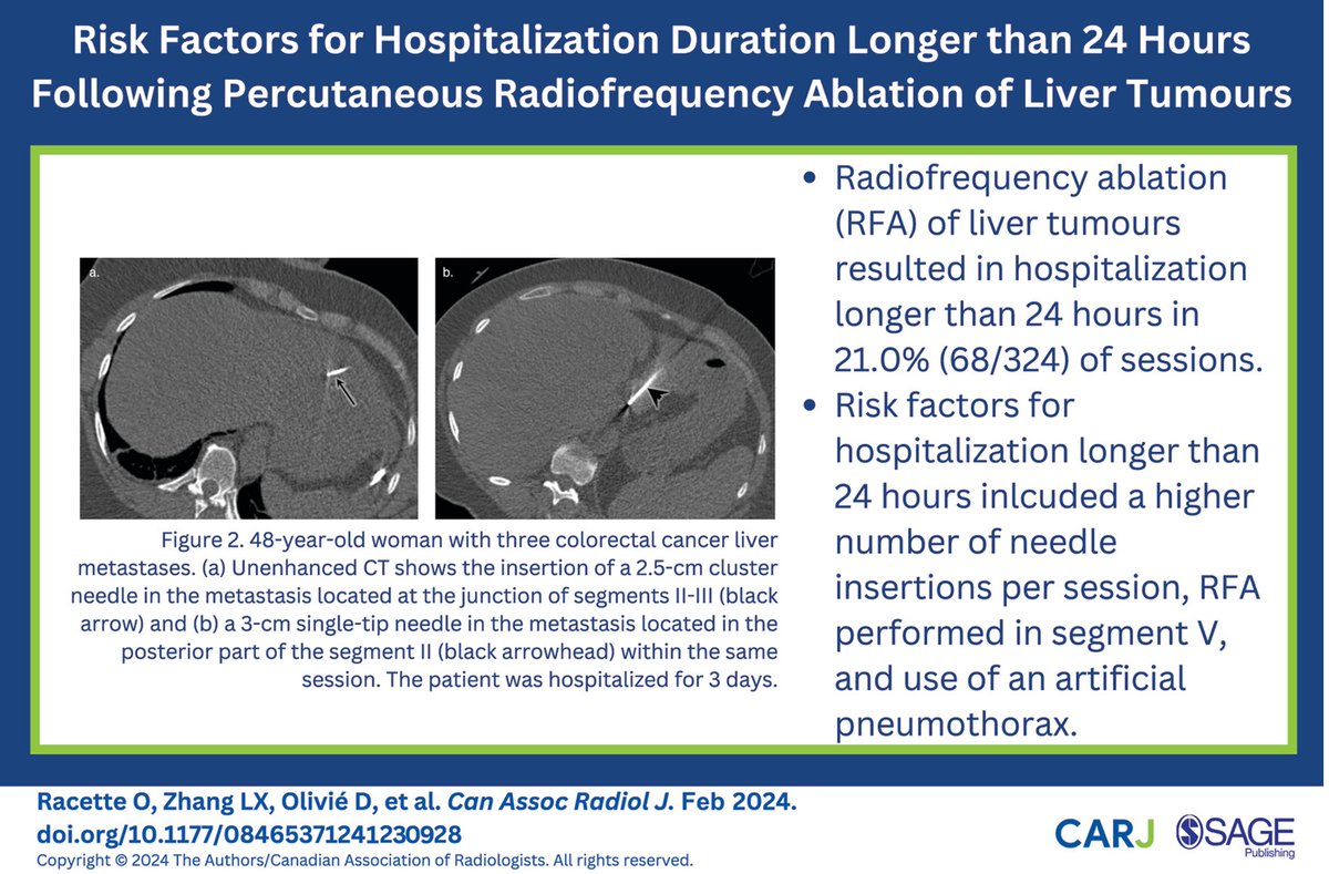 This recently published study assesses risk factors for hospitalization <24 hours following percutaneous radiofrequency ablation of liver tumours: doi.org/10.1177/084653… @Duotango @CARadiologists @SageJournals #radiology #radres