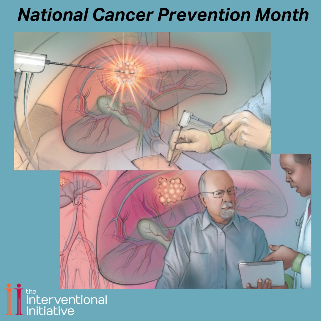 February marks National Cancer Prevention Month, emphasizing proactive steps against this disease. Did you know, many cancers, like liver cancer, can be effectively treated with minimally invasive procedures, such as ablation, radioembolization (TARE), or chemoembolization…