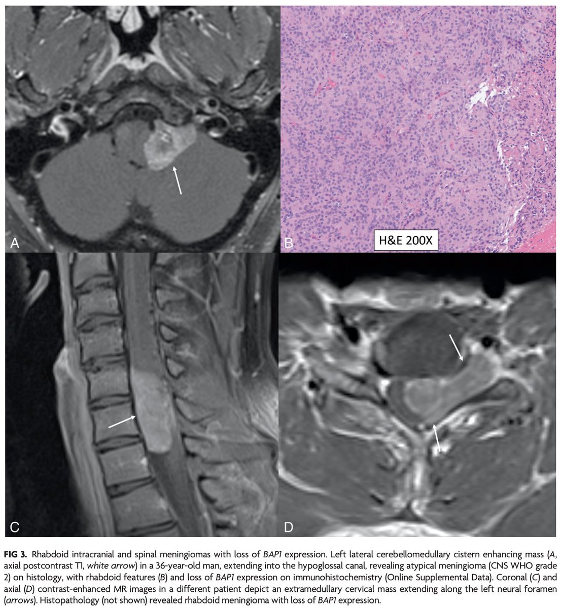 'Newly Recognized Genetic Tumor Syndromes of the CNS in the 5th WHO Classification: Imaging Overview with Genetic Updates' doi.org/10.3174/ajnr.A… @amitagarwalmd #OpenAccess #FellowsJournalClub #SupplementalOnlineData