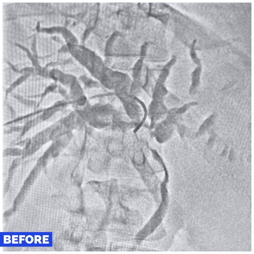 MumbaiIR's tweet photo. Obstructive jaundice with cholangitis,  infiltration of ducts. Initial drainage with PTBD. Rt Ant Internalized, Left to RPD for max early decomp. #irad #gastromed #MedEd #MedX #ptbd #Gimed #drainthebile @JVIRmedia @ISVIRIndia @GastroKarger @GlobalHepato @journalofgastro #Mumbai https://t.co/STc4TY0LxQ