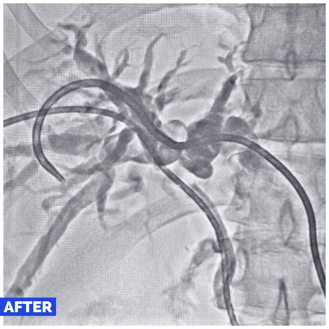 Obstructive jaundice with cholangitis,  infiltration of ducts. Initial drainage with PTBD. Rt Ant Internalized, Left to RPD for max early decomp. #irad #gastromed #MedEd #MedX #ptbd #Gimed #drainthebile @JVIRmedia @ISVIRIndia @GastroKarger @GlobalHepato @journalofgastro #Mumbai