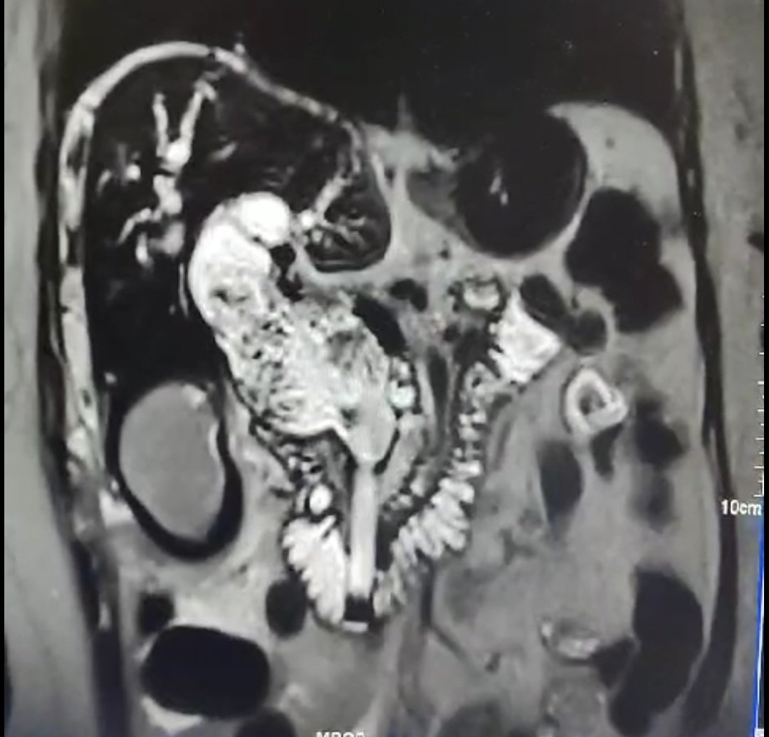 somubetageri's tweet photo. IPMN of GB infiltrating into CBD upto hilum. Blocked metallic stent and plastic stent through it. Palliative percutaneous hepatico gastrostomy. https://t.co/EisOfZ4YH0