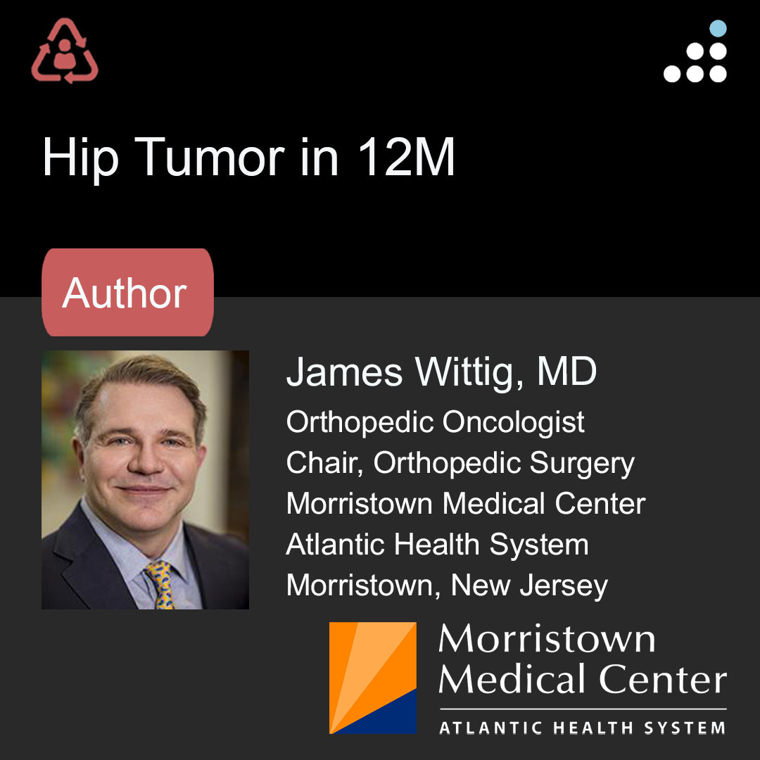 Here are intra-op & post-op images of yesterday's case by @DrJamesWittig and Morristown Medical Center | @AtlanticHealth System.

HIP TUMOR IN 12M

PROCEDURE: Open Biopsy, intraoperative frozen section to confirm the diagnosis of chondroblastoma, followed by Intralesional