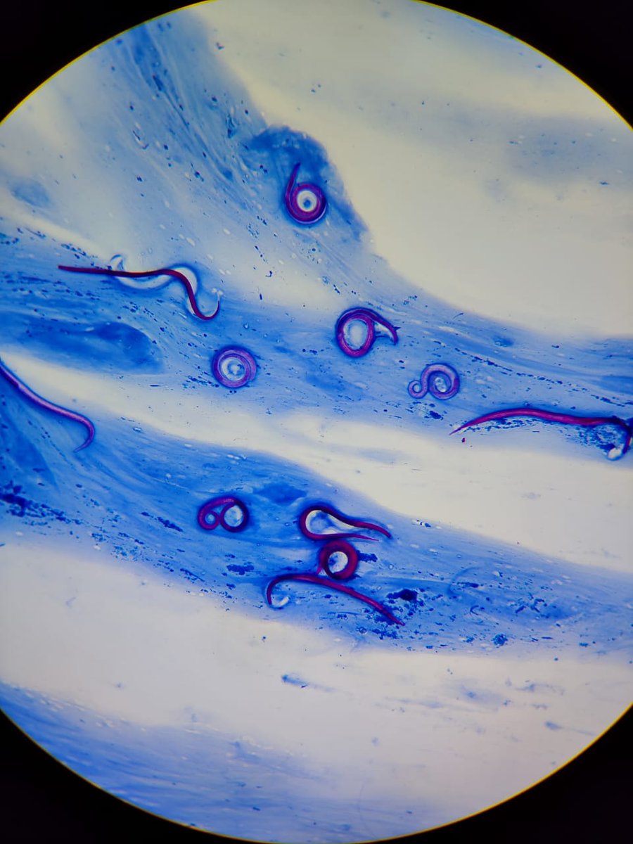 Strongyloides stercoralis en muestra BK de esputo, coloración de Ziehl Neelsen