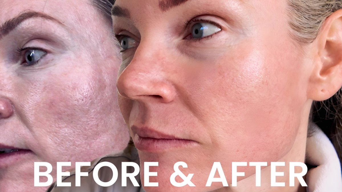 SpaAndTellYT's tweet photo. VBEAM Face LASER Treatment
FEB 29th Thurs 5:15pm PST | 8:15 PM EST LIVE PREMIERE
LINK: https://t.co/vtQGg1LmFl
#VBEAM #FaceLASER #beforeandafter #spaandtell https://t.co/FDSlxGu7Fb