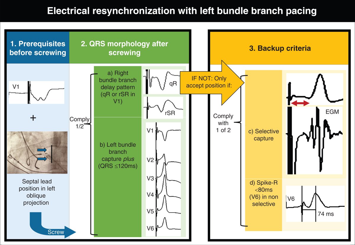 Electrical resynchronization #resynchroCriteria academic.oup.com/europace/artic…