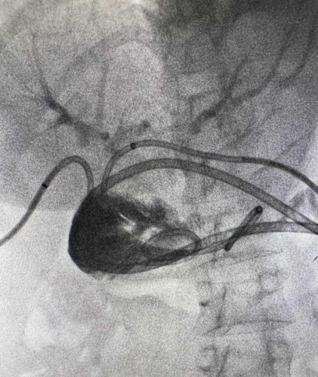 Ahmed Kamel MD, PhD, FSIR (@ahmed_kamel_ir) on Twitter photo Patient with hepaticojujenostmy and postanastomotic stricture of left bile duct which drains the left and right anterior bile ducts. Sharp recanalization was performed, followed by balloon angioplasty and placement of internal-external biliary drain <a href="/UTHouston_IR/">UT Houston_IR</a> <a href="/HCIRad/">Houston Combined IR Residency</a> Patient with hepaticojujenostmy and postanastomotic stricture of left bile duct which drains the left and right anterior bile ducts. Sharp recanalization was performed, followed by balloon angioplasty and placement of internal-external biliary drain <a href="/UTHouston_IR/">UT Houston_IR</a> <a href="/HCIRad/">Houston Combined IR Residency</a>