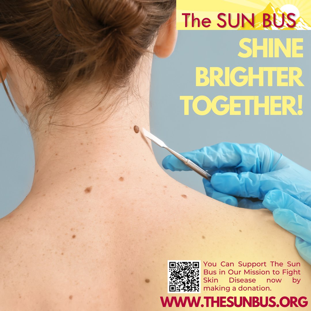 💛Every donation counts! Support The Sun Bus in providing free skin cancer screenings and combating skin disease. Let's spread the word and make a difference together. Scan the📲QR code to donate now! ☀️🚌 #SunBus #SkinHealth #DonateForChange